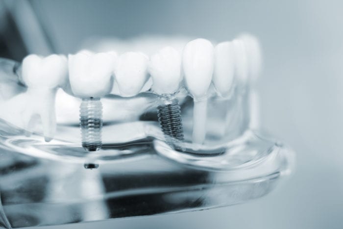 dental implants for missing teeth in Fox Lake Illinois