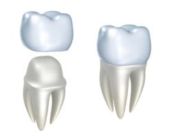 dental crown in Fox Lake, IL