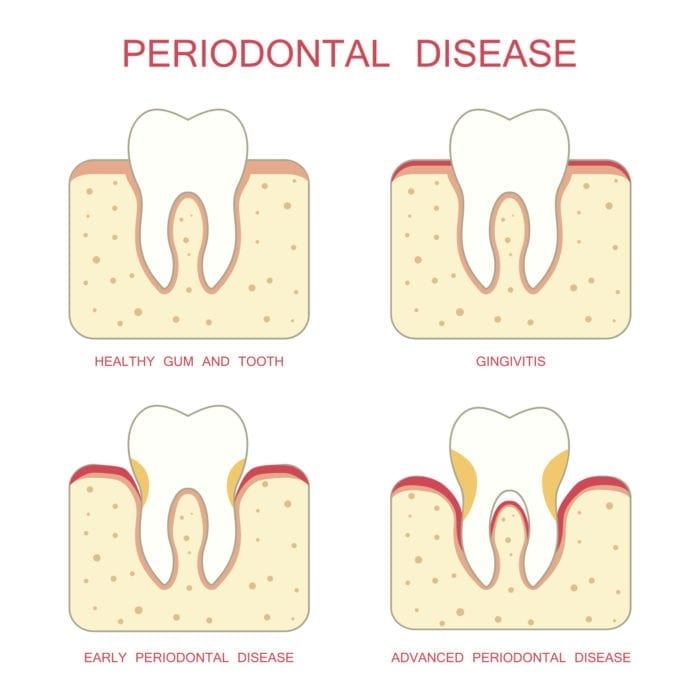 Treatment for gum disease in Fox Lake Illinois