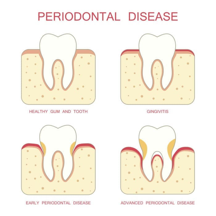 Treatment for gum disease in Fox Lake Illinois