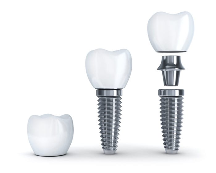 Is A Single Tooth Dental Implant Right For Me?