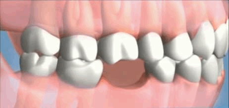 Single dental implant for missing teeth