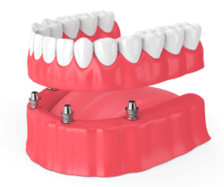 Dental implant-secured Denture in Fox Lake Illinois