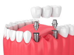 Implant-supported dental bridge in Fox Lake Illinois