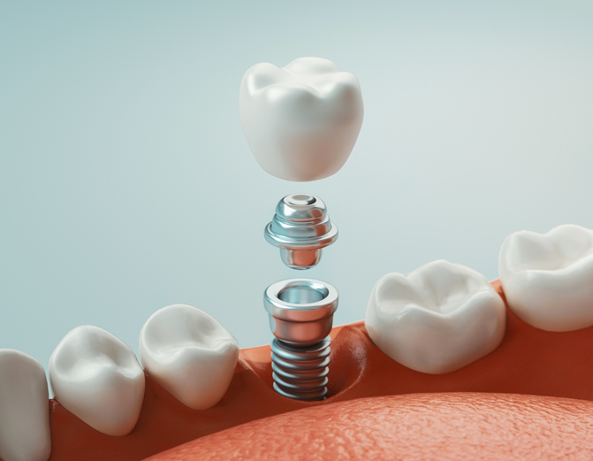 Dental Implants Fox Lake, IL