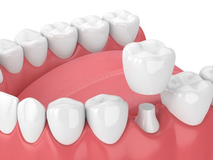 dental crown treatment in Fox Lake Illinois