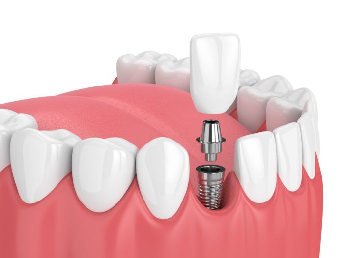 protect your dental implants Fox Lake Illinois
