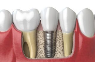 Will Implants Affect Other Dental Work