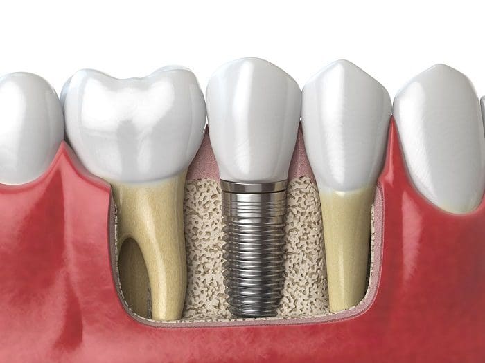 Will Implants Affect Other Dental Work