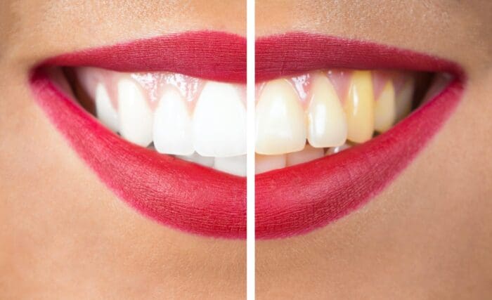 This article will guide you through the professional teeth whitening process, highlight its benefits, and offer post-treatment care tips.