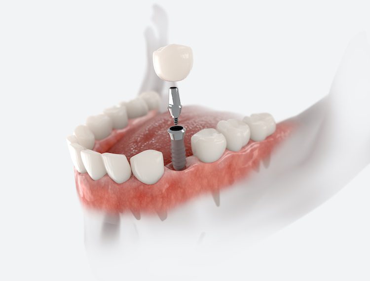 Understanding the dental implant process can help patients make informed decisions and alleviate anxiety about their treatment.