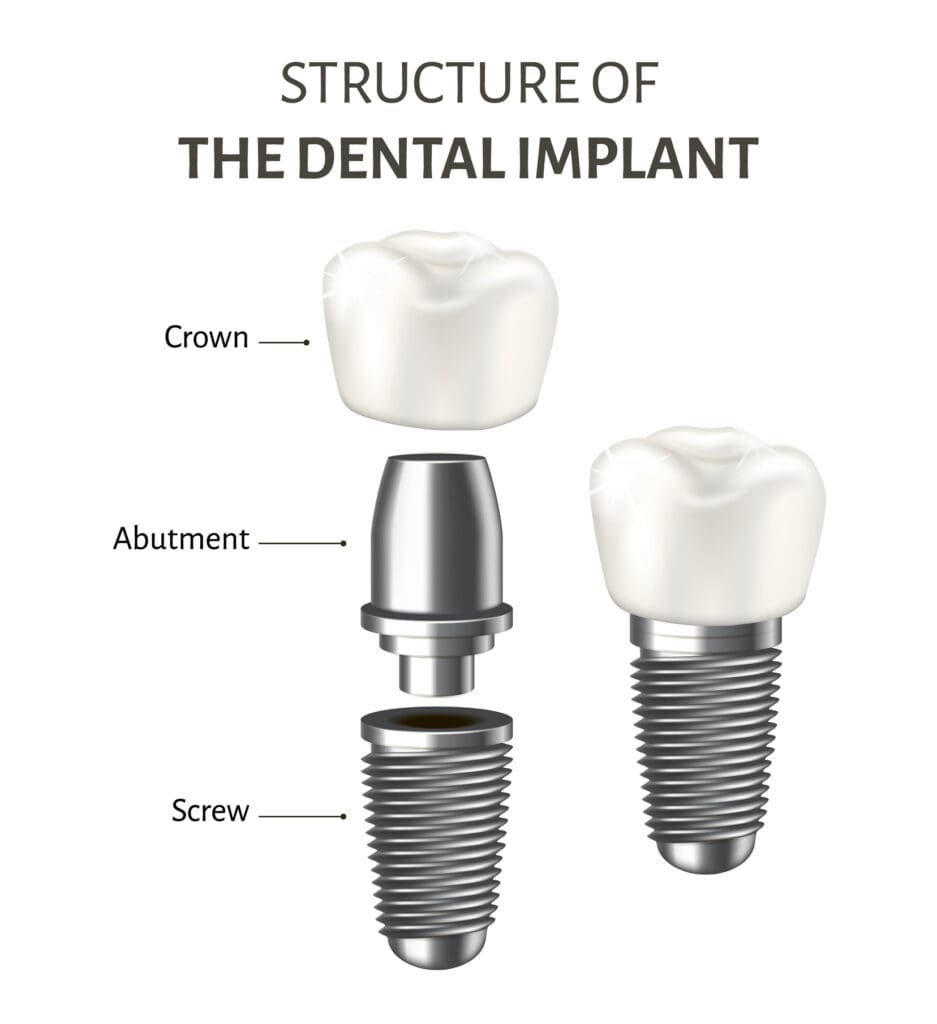 Dental Implants in Fox Lake IL