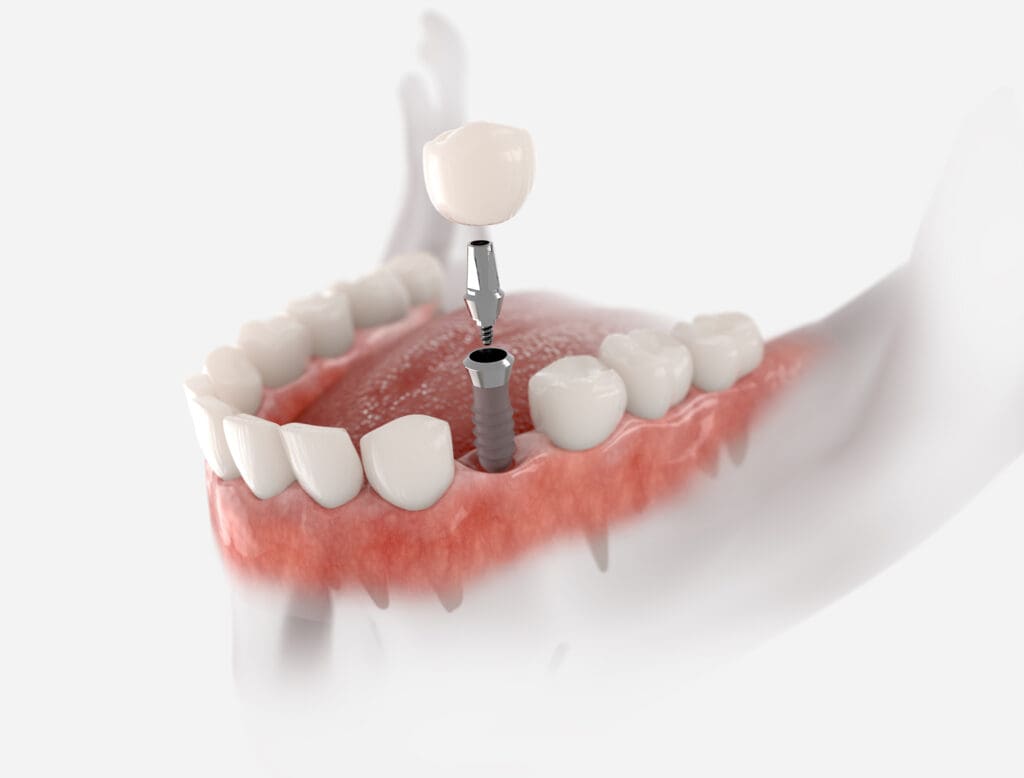 dental implants fox lake il