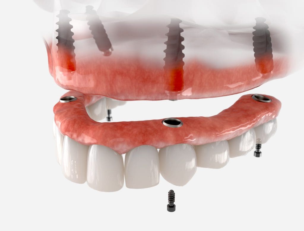 dental implant dentures fox lake il