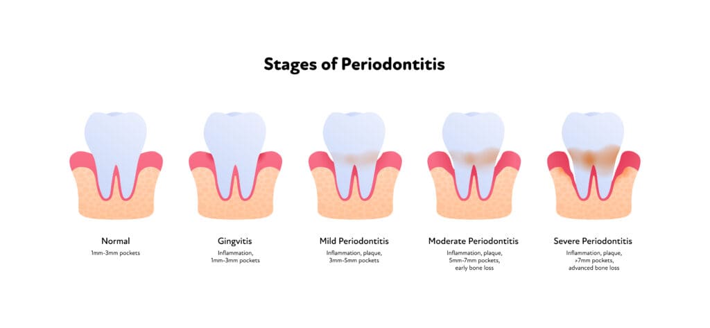 Treatment for gum disease in Fox Lake Illinois