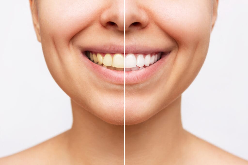 teeth whitening in Fox Lake, IL