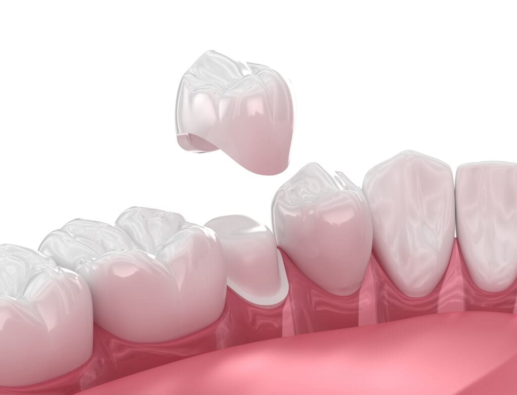 dental crown in Fox Lake, IL