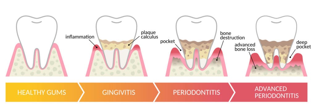 treatment for gum disease in fox lake il