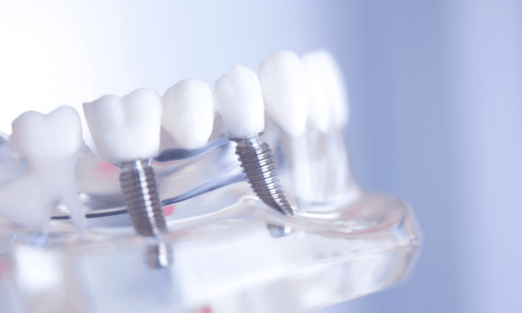 Two primary types of dental bridges exist: traditional and implant-supported bridges. Each type offers unique benefits and drawbacks.